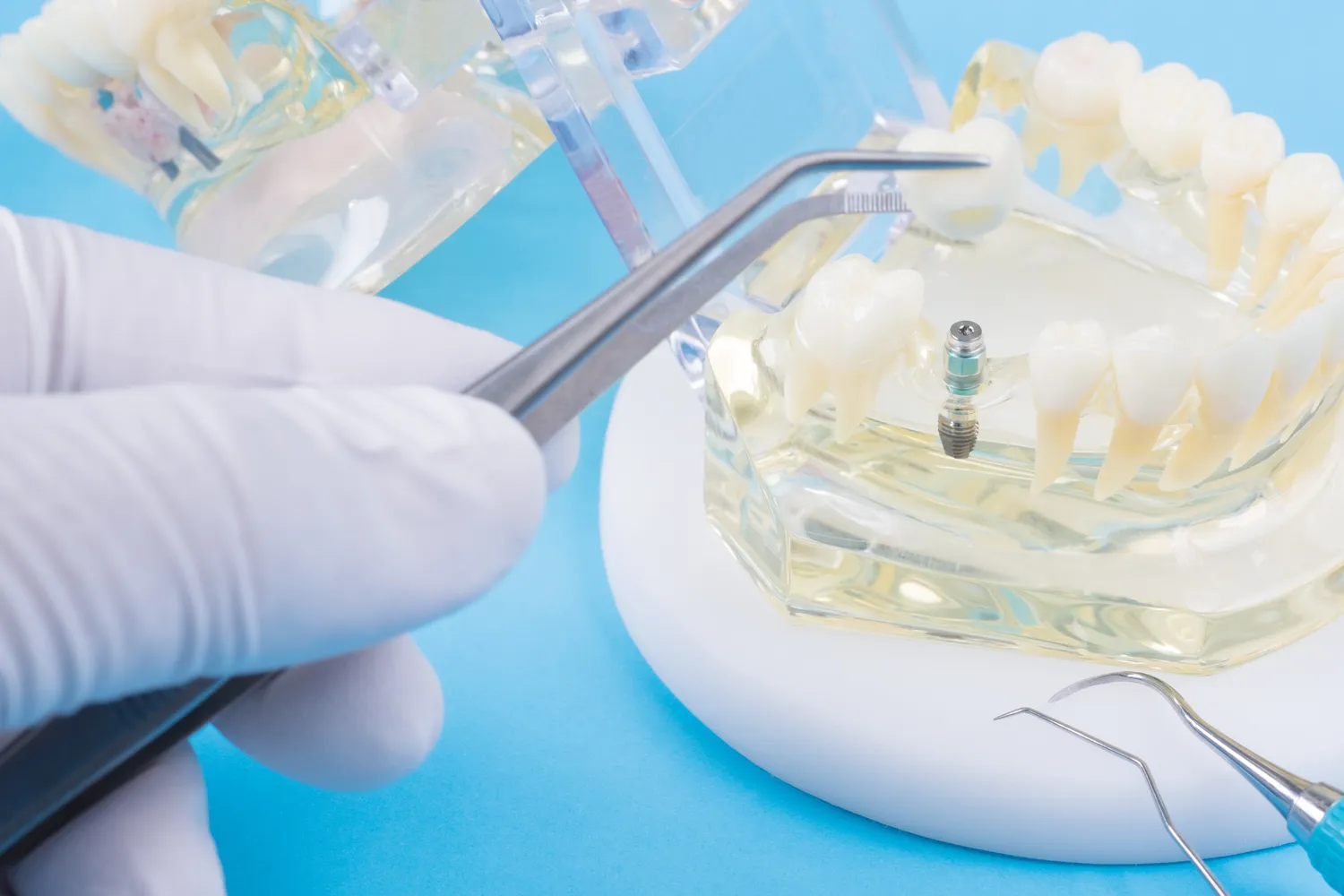 Ile kosztuje wymiana zębów na implanty?