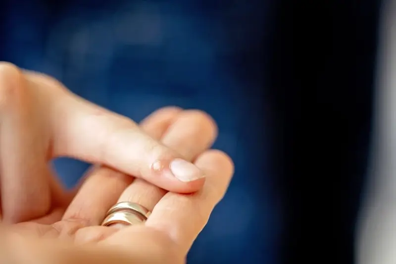 Od czego robią się kurzajki?